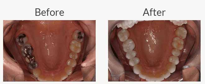 Change Metal Fillings - Dr Ronald Chaiklin