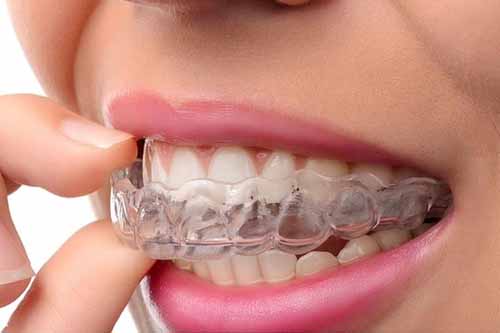 Clear Aligners - Dr Ronald Chaiklin