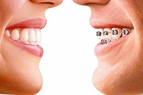 Orthodontic Treatment by Dr Ronald Chaiklin.